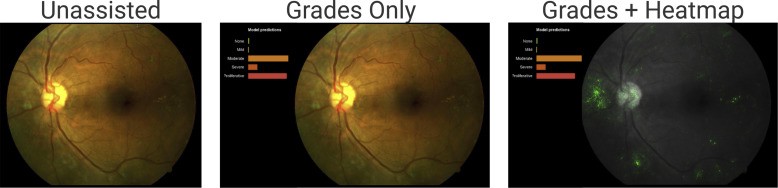 Ophthalmologists were better at detecting DR when aided by deep learning models and their associated decision heat maps, like the one above. Source: [https://www.aaojournal.org/article/S0161-6420(18)31575-6/fulltext](https://www.aaojournal.org/article/S0161-6420(18)31575-6/fulltext)